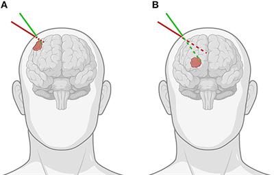 Neuro-oncological augmented reality planning for intracranial tumor resection